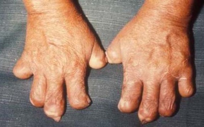 Chấm dứt phân biệt đối xử các nạn nhân bị bệnh phong?