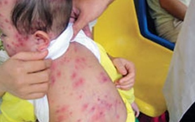 Chưa xuất hiện bệnh nhi sởi, rubella; lác đác ca thuỷ đậu