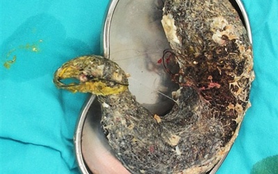 Phát hoảng vì búi tóc 2kg trong bụng bé gái