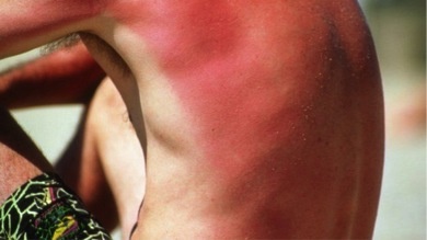 Nguy cơ ung thư da từ những kỳ nghỉ mát