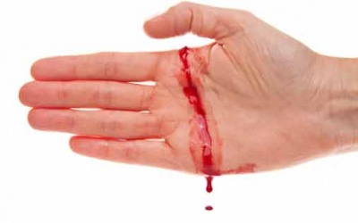 60% bệnh nhân Hemophilia chưa được điều trị thường xuyên