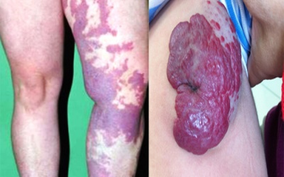 Chữa dị dạng mạch máu bằng can thiệp nội mạch