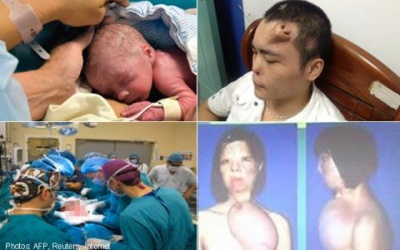 Những ca ghép bộ phận cơ thể hy hữu trên thế giới