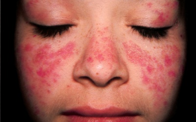 Lupus ban đỏ: 'Sự nhầm lẫn' của cơ thể