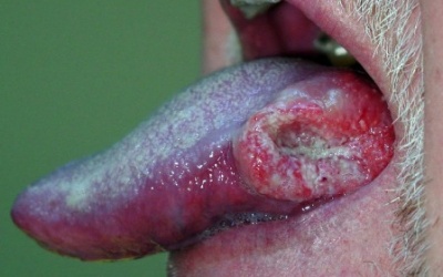 Ung thư miệng do HPV?