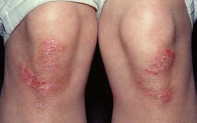 ​Điều trị vảy nến và nguy cơ bị “giời leo”