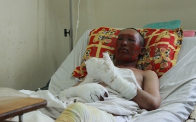 Nổ lò luyện thép, 2 công nhận bị bỏng sâu