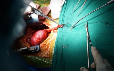 Ghép thận thành công cho bệnh nhân bị suy thận giai đoạn cuối