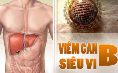 Viêm gan siêu vi B mạn tính: Âm thầm nhưng nguy hiểm tính mạng