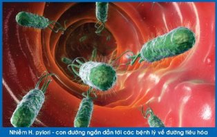 Dấu hiệu bạn bị nhiễm khuẩn H. pylori dạ dày