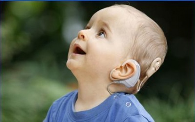Cấy điện cực ốc tai, 80 trẻ cải thiện chức năng nghe, nói