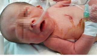 Lần đầu tiên gây mê kết hợp gây tê cho trẻ sơ sinh thiếu tháng