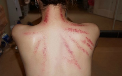 Những sai lầm nguy hiểm khi cạo gió