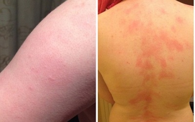 Dị ứng với cả nụ hôn của chồng