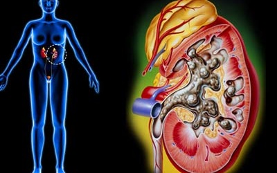 Mắc suy thận mạn: Bản án tử hình