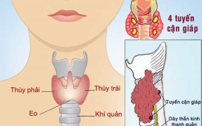 Khi nào cần phẫu thuật tuyến giáp?
