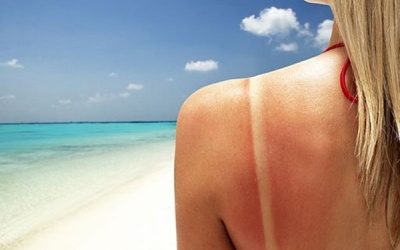 Mẹo phục hồi da cháy nắng do đi biển