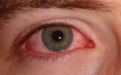 Vì sao mắt nhìn mờ sau khi điều trị viêm kết mạc?