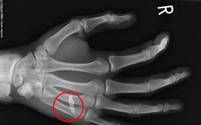 Lấy chiếc răng cửa trong xương tay thanh niên