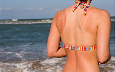 Mẹo phục hồi da cháy nắng sau đi biển