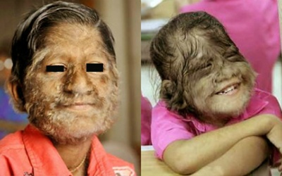 Những bệnh lạ lùng ở con người