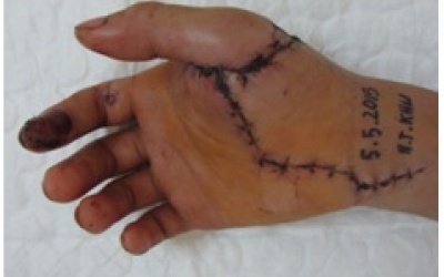 Nối thành công ngón tay đứt lìa cho bệnh nhân 