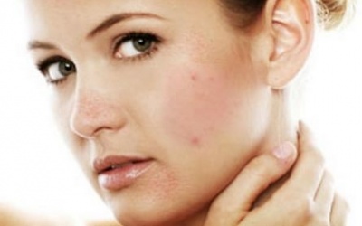 Bị viêm da tiết bã nhờn nên dùng thuốc gì?