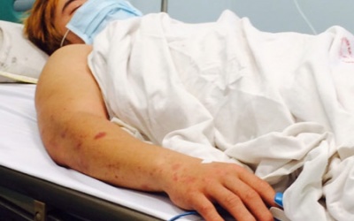 Gia tăng bệnh nhân mắc viêm màng não do não mô cầu