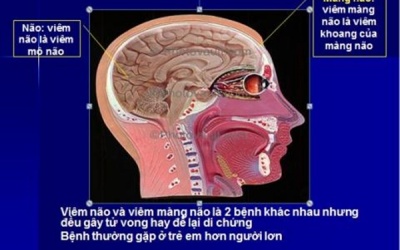 Bệnh viêm màng não gia tăng