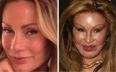 Giật mình với hình ảnh sao biến dạng vì... phẫu thuật thẩm mỹ