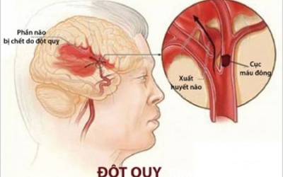 Video: 5 phút lại có 1 người bị đột quỵ