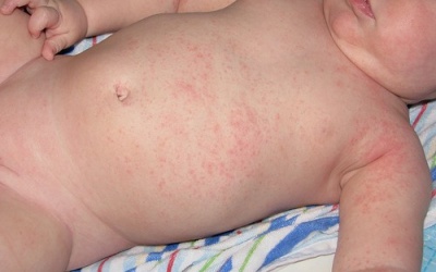 Cách trị rôm sảy hiệu quả cho bé mùa nắng nóng