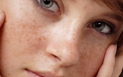 Thổi bay tàn nhang nhờ bí xanh và mướp đắng