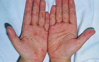 Cách điều trị bệnh tổ đỉa