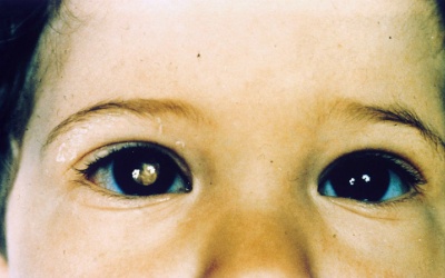 Cậu bé được phát hiện ung thư mắt nhờ bức ảnh mẹ chụp