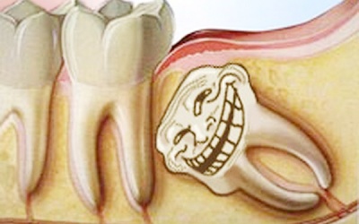 Khi nào nên nhổ răng khôn?