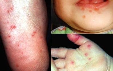 Ai dễ mắc bệnh tay chân miệng?