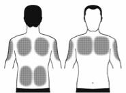 Điều trị sa sút trí tuệ trong Alzheimer bằng miếng dán
