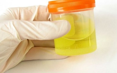 Nước tiểu cảnh báo tình trạng sức khỏe