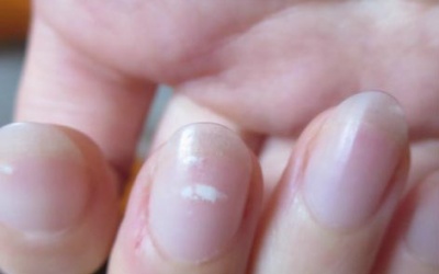 Móng tay có đốm trắng là bệnh gì?