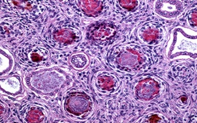 Bệnh sốt mò “rình” người đi phượt