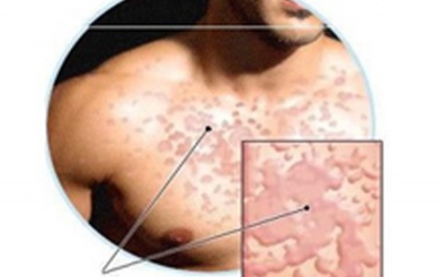 Biện pháp tự nhiên cho những người hay nổi mề đay