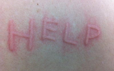 Bị phát ban cần lưu ý những gì?