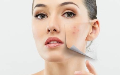 Sự thực về mụn trứng cá ở người trưởng thành