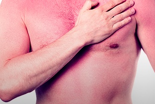 Thuốc nào điều trị bệnh đỏ da toàn thân?