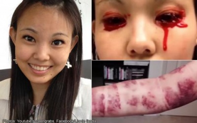 Bệnh lạ khiến thiếu nữ trào máu mắt và miệng