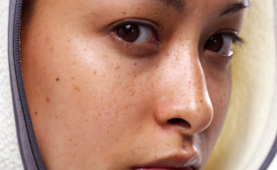 Ôi… tàn nhang!!!