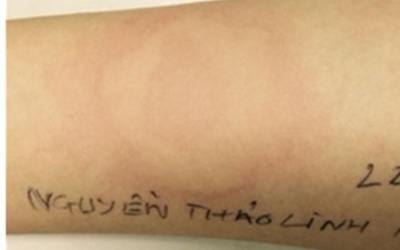 Phù nề thanh quản, khó thở sau một cốc nước đá