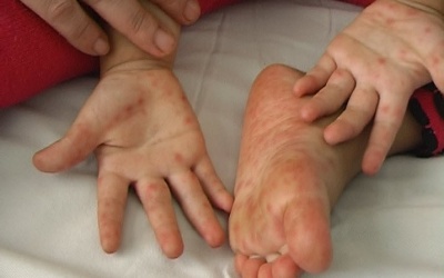 Lâm Đồng: Bé gái 3 tuổi tử vong vì bệnh tay chân miệng