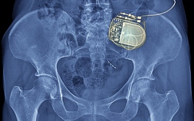 Kích thích tủy sống, điều trị cơn đau thắt lưng mạn tính